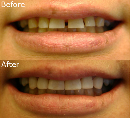 Veneer Before After