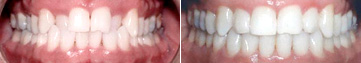 Invisalign Before After