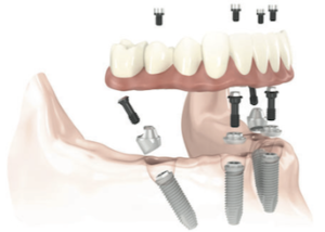 Dental Implants