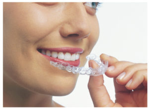 Invisalign Aligner