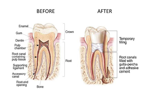 Endodontics and Root Canals