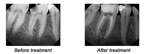 Endodontics and Root Canals