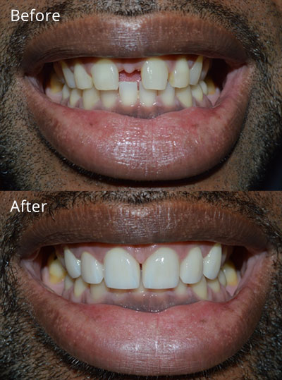 crooked teeth before and after veneers