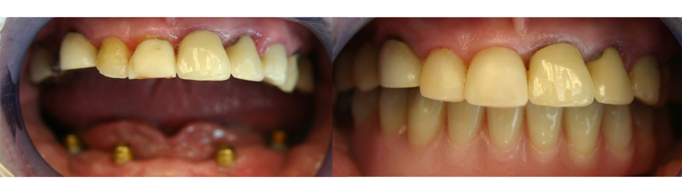 Locator Restoration Gallery